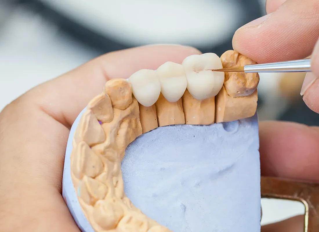 Dental Bridges in Torrance, CA