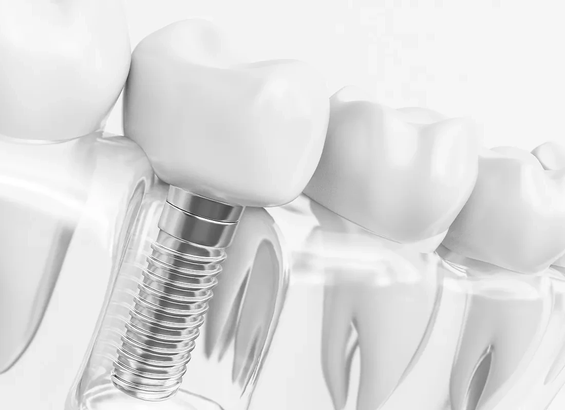 5 Signs You Need a Dental Implant
