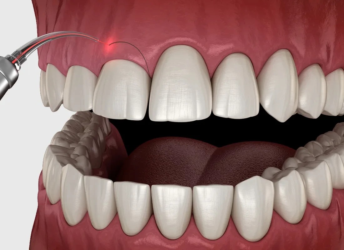Gum Contouring in Torrance, CA