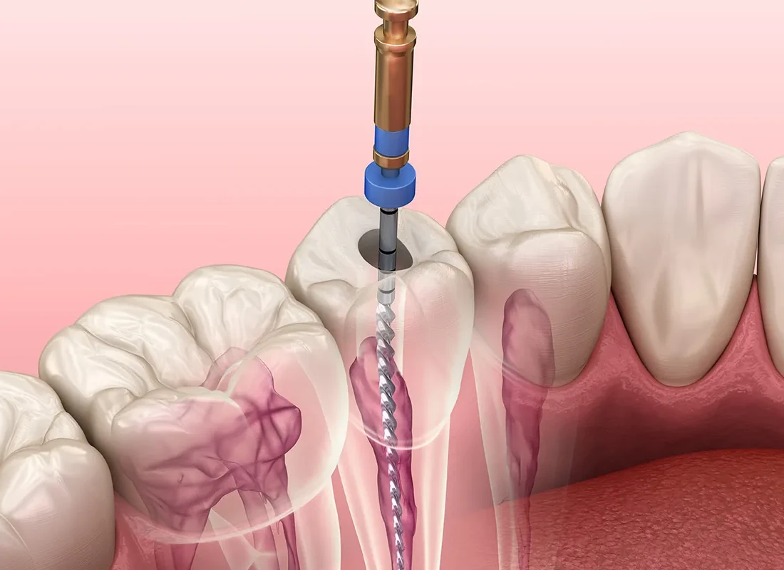 What Is a Root Canal and Does It Hurt?