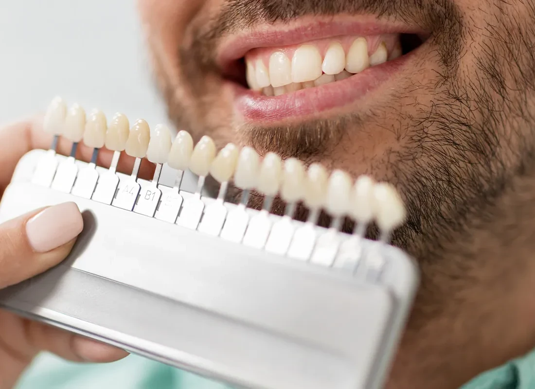 All You Need to Know About Teeth Whitening