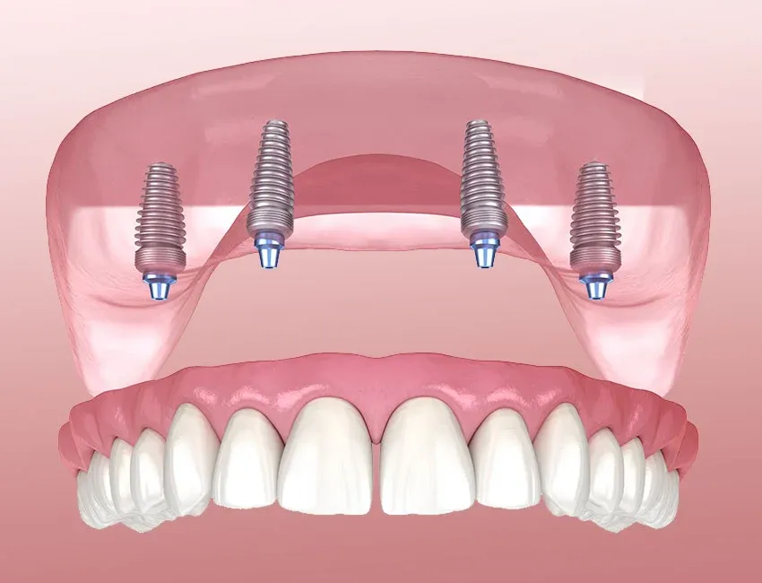 Signs you may need all-on-4 dental implants — Torrance Dental Spa