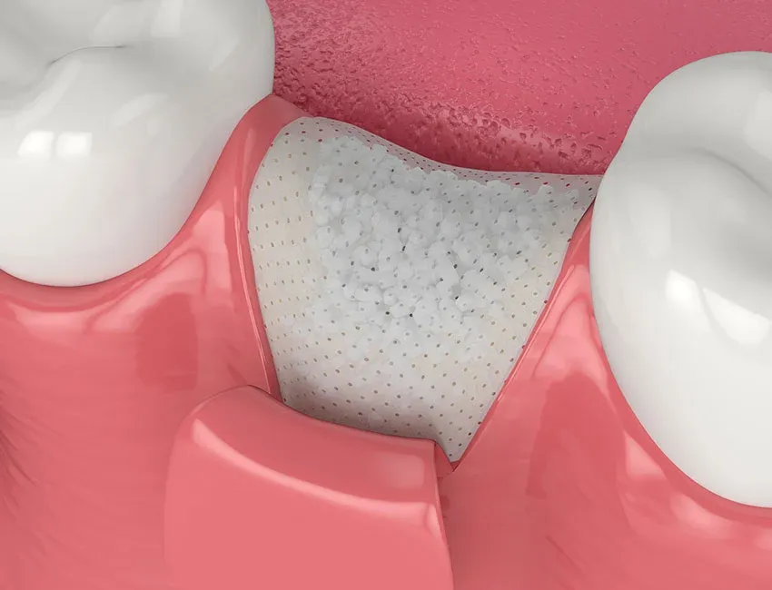 Dental Bone Grafting in Torrance, CA