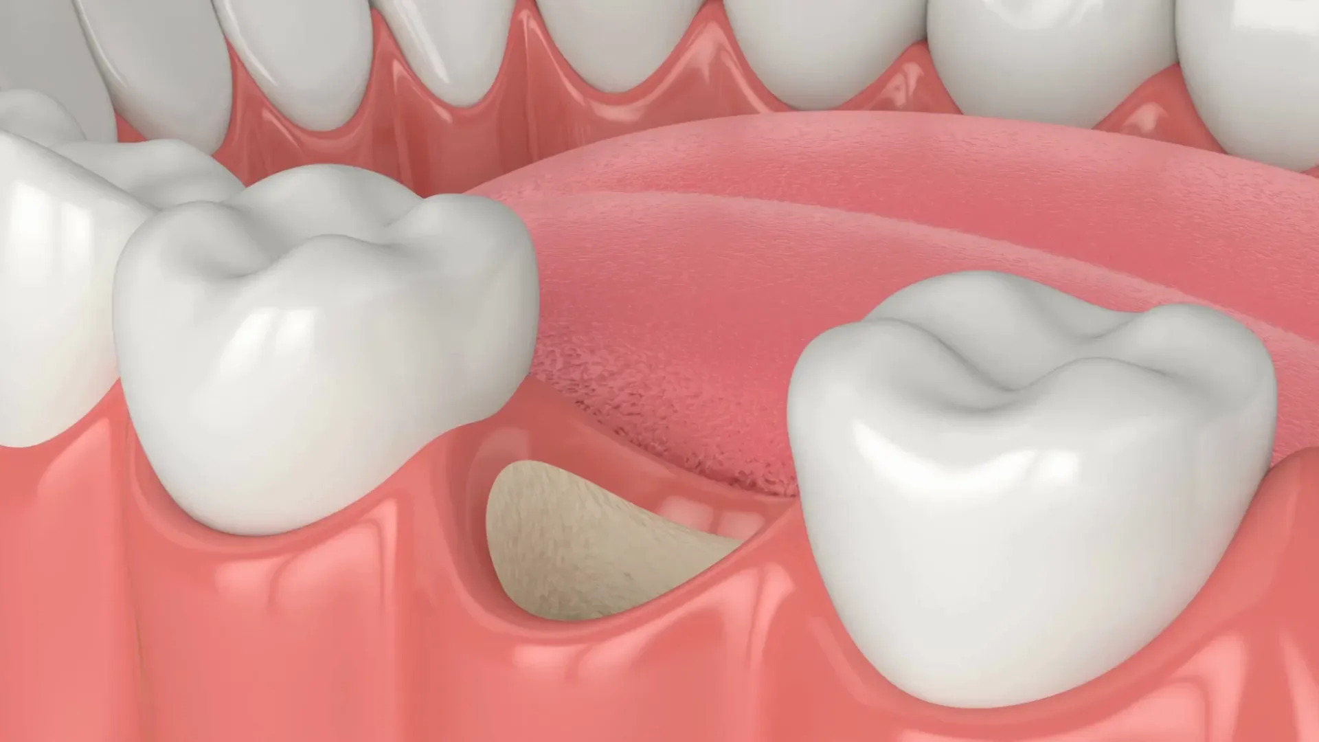Dental Bone Grafting at Torrance Dental Spa
