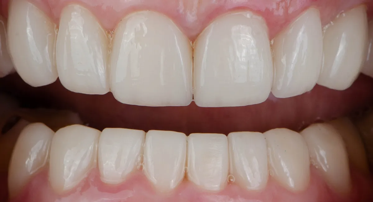 After — smile case 8