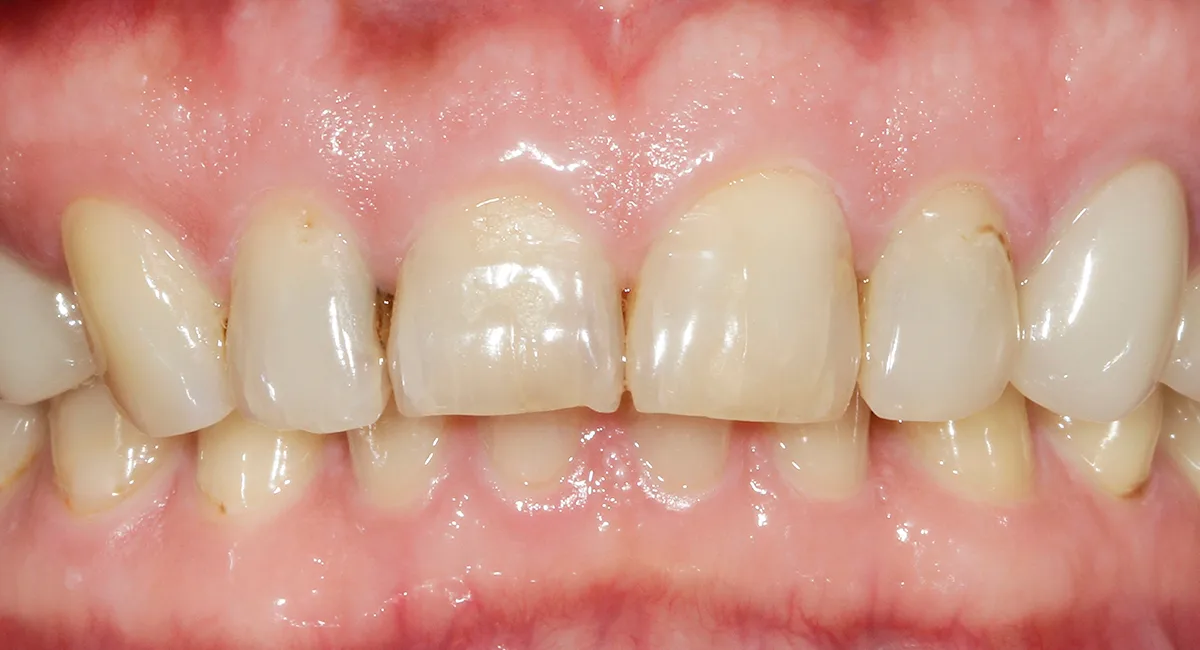 Before — smile case 9