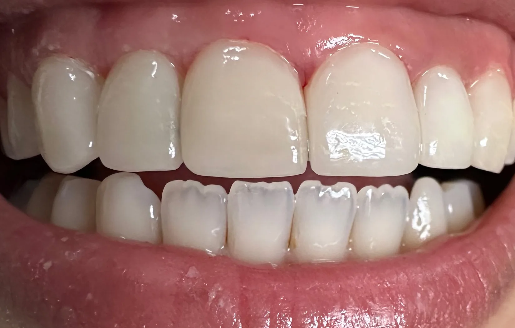 After — Worn, uneven upper front teeth rebuilt to a straight, even edge — Case 1