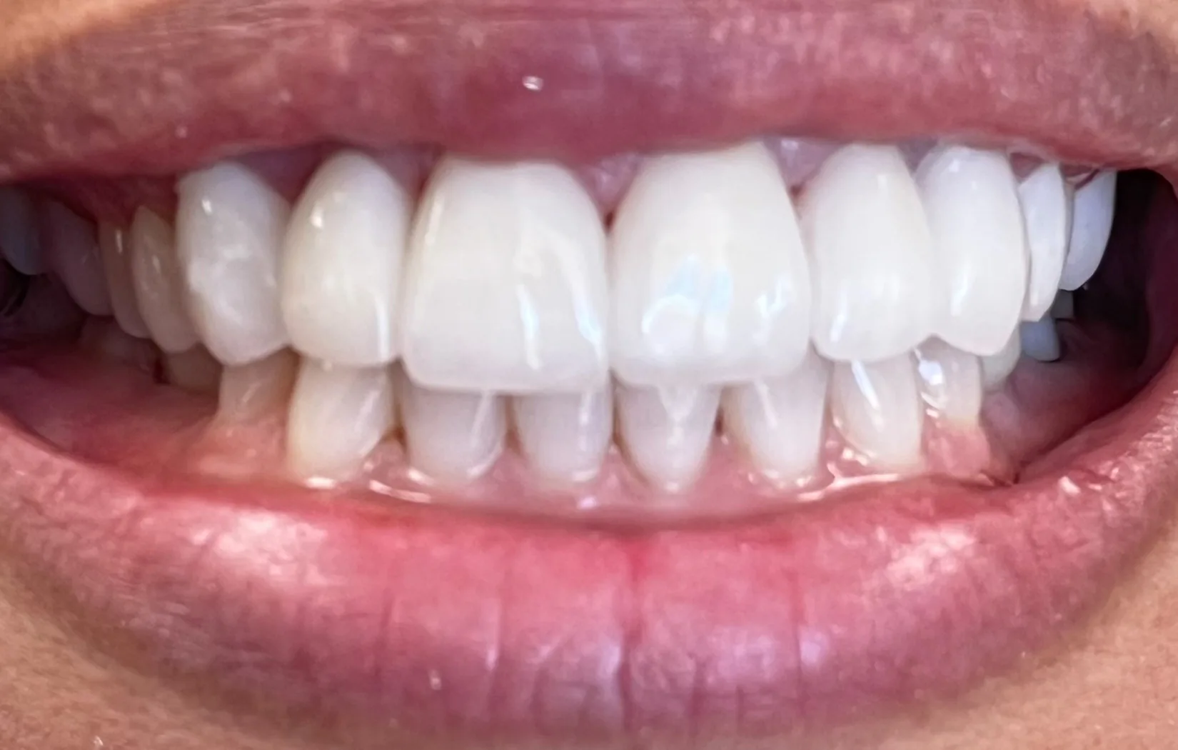 After — Staining along the gum line cleared and the edges evened out — Case 2