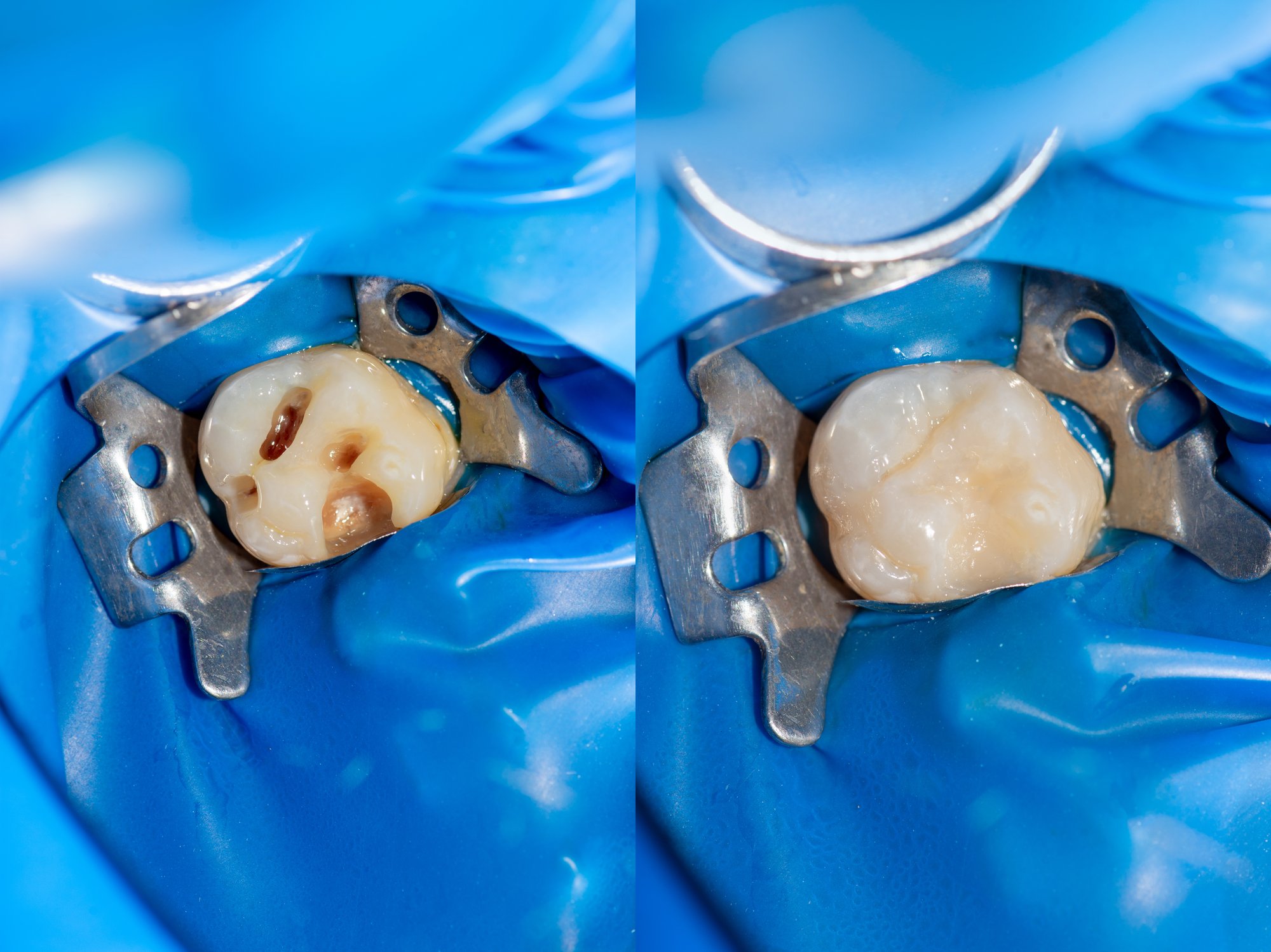 What Happens If I Put Off Filling a Cavity?