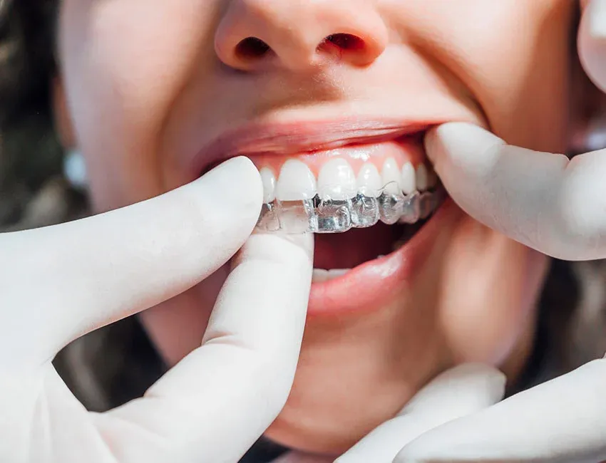 Signs you may need invisalign — Torrance Dental Spa