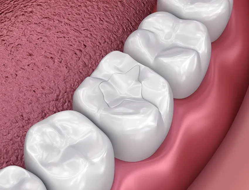 Dental Fillings at Torrance Dental Spa