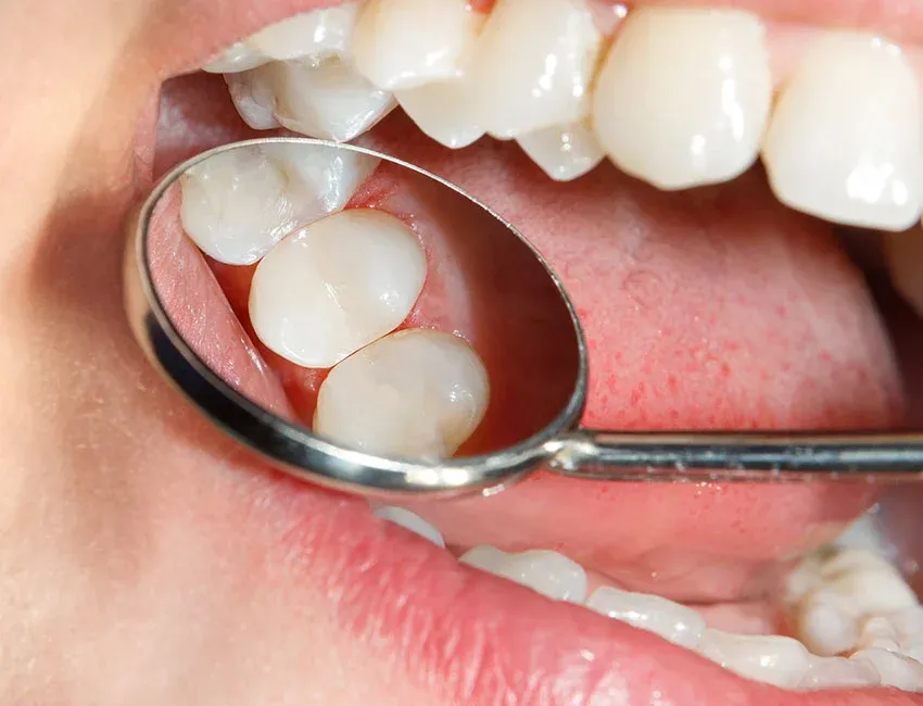 Dental Bonding, Shaping, and Contouring at Torrance Dental Spa