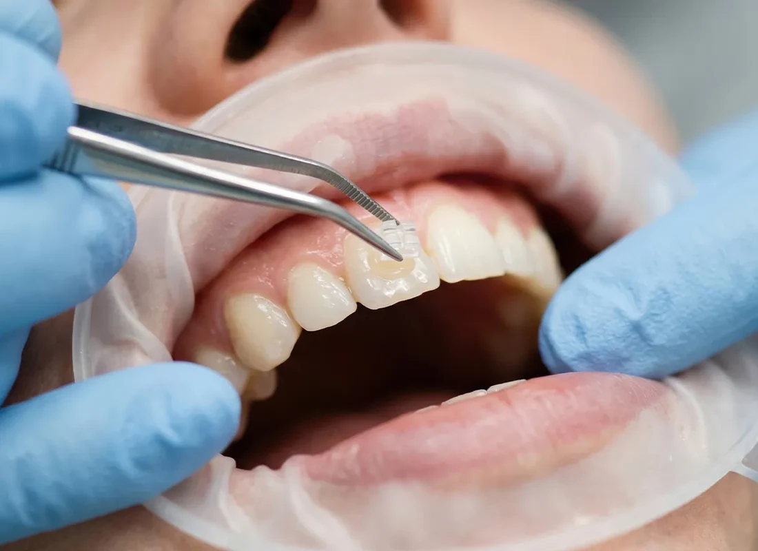 Dental Bonding, Shaping, and Contouring in Torrance, CA