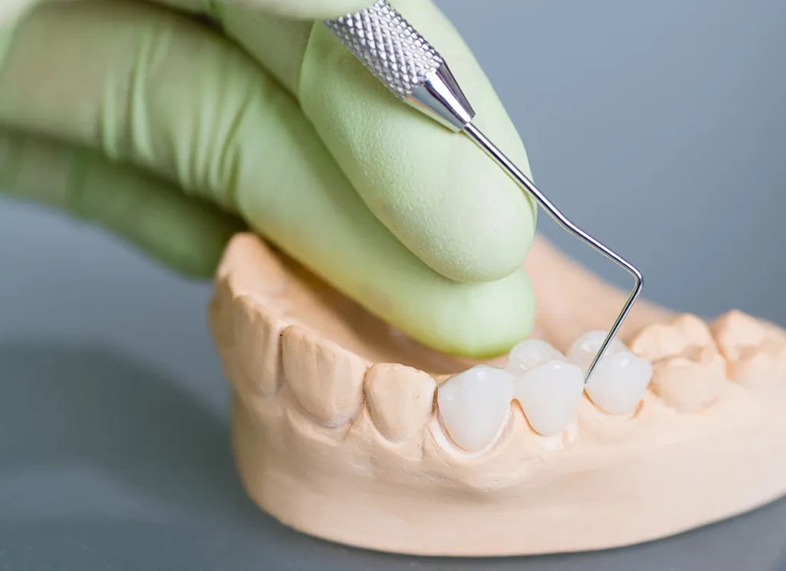 Dental Bridges at Torrance Dental Spa
