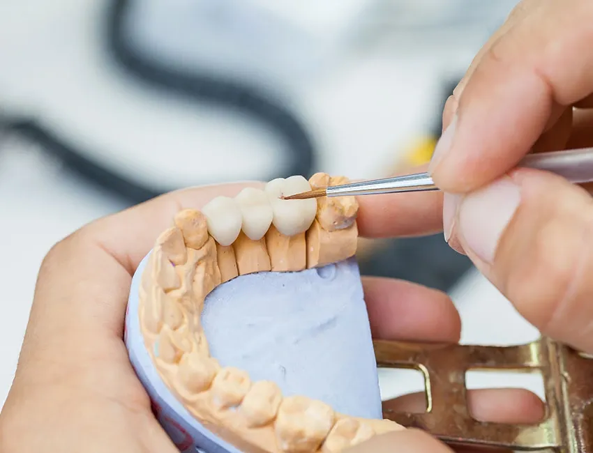Signs you may need dental bridges — Torrance Dental Spa