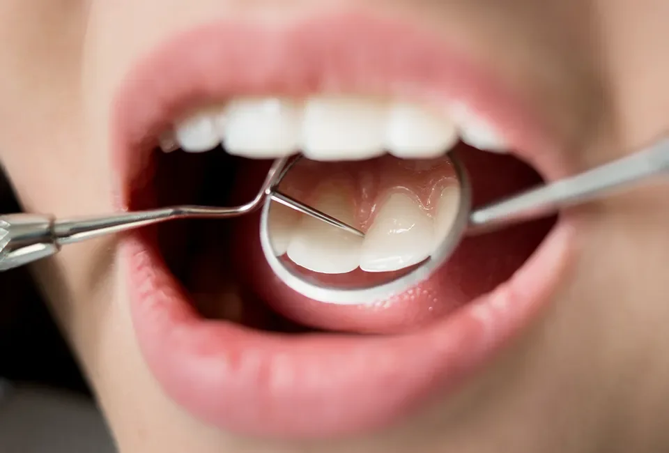 Bleeding Gums When Brushing: Should Torrance Patients Worry?