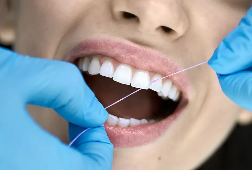 How Often Should I Floss to Prevent Cavities?