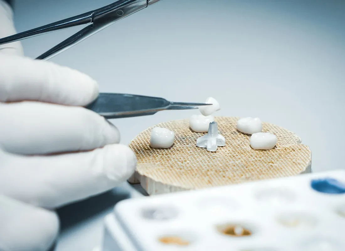 Signs you may need dental crowns — Torrance Dental Spa