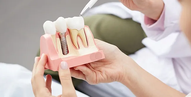 Dental Implants vs. Dental Bridge: Which One Saves You More Money in the Long Run?