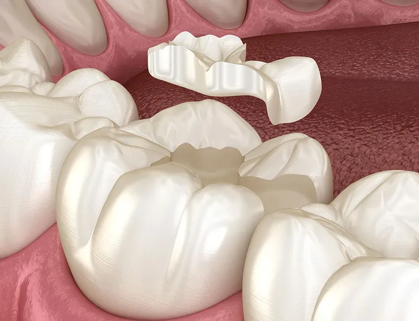 Dental Inlays and Onlays at Torrance Dental Spa