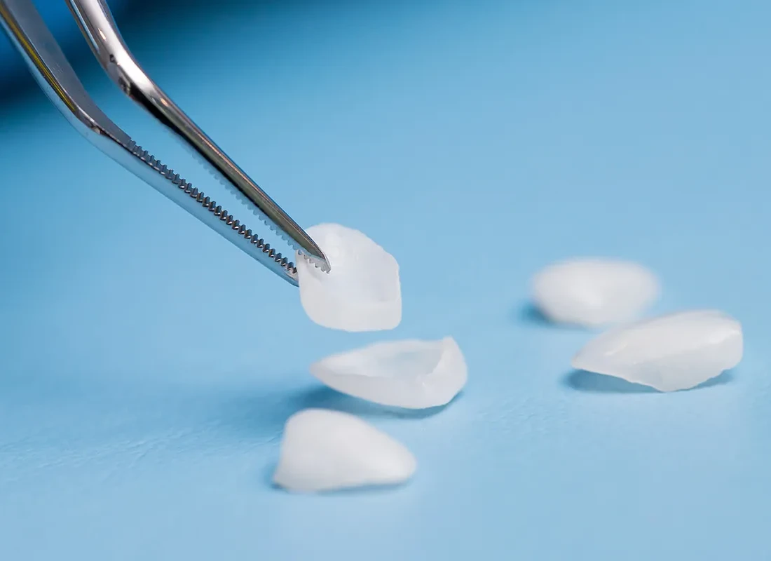 Porcelain Veneers in Torrance, CA