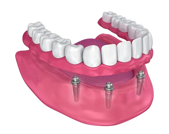 Snap-In Dentures at Torrance Dental Spa