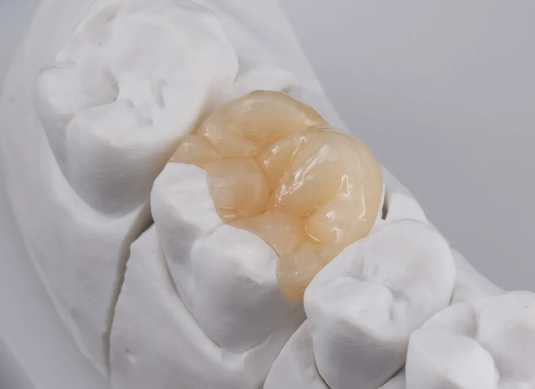 Dental Inlays and Onlays in Torrance, CA
