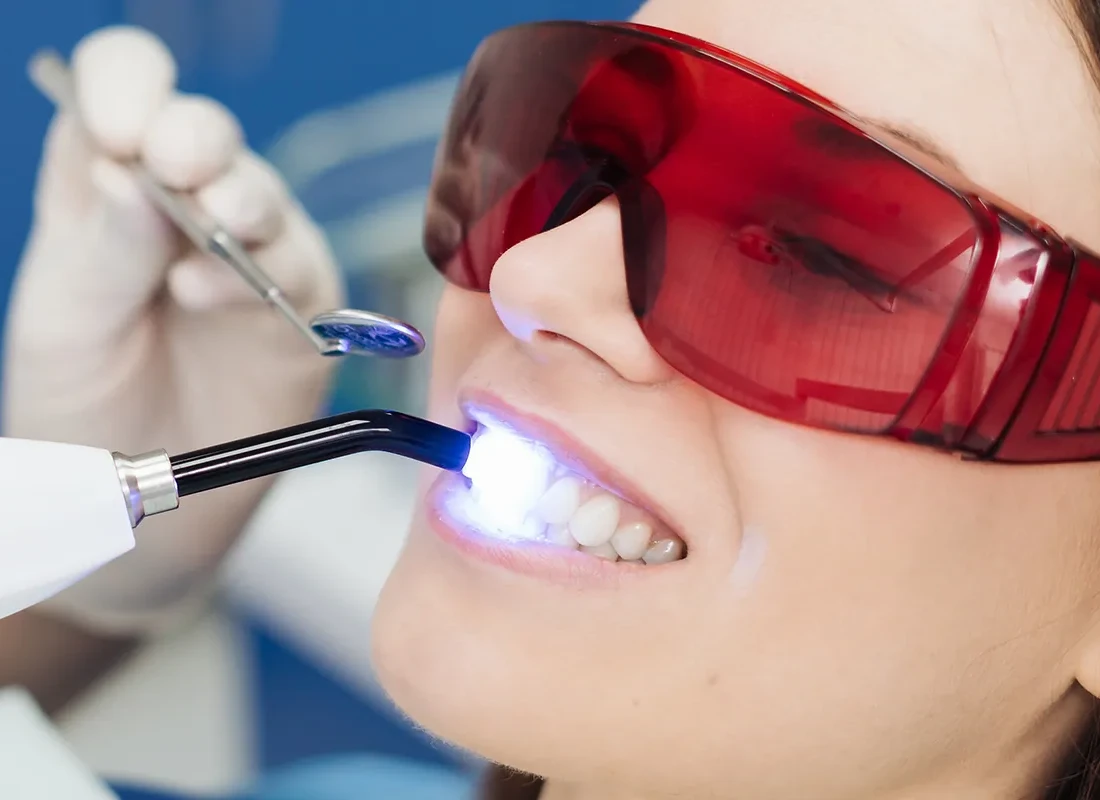 Gum Contouring at Torrance Dental Spa
