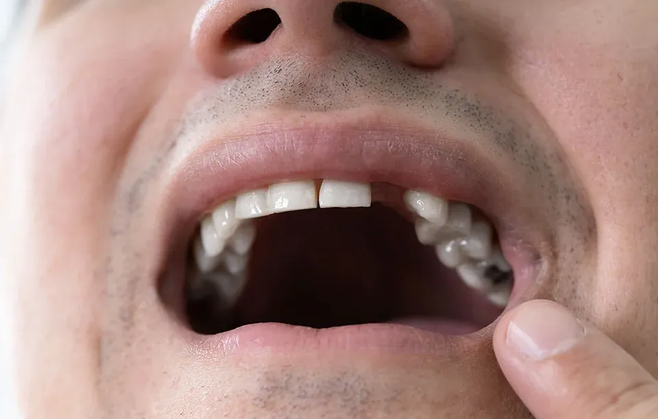 The Ultimate Guide to Replacing Missing Teeth: Restoring Your Smile in Torrance, CA