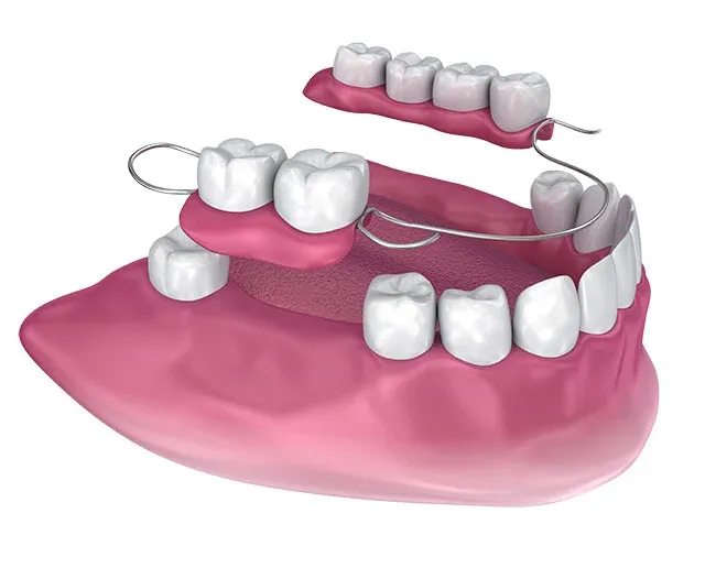 Full and Partial Dentures at Torrance Dental Spa
