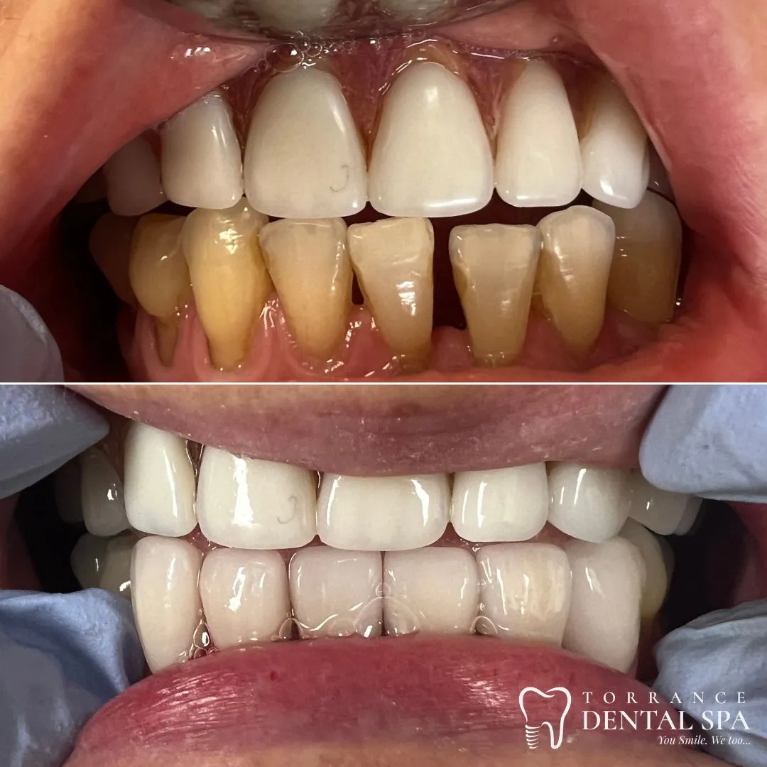 Before and after — smile case 1