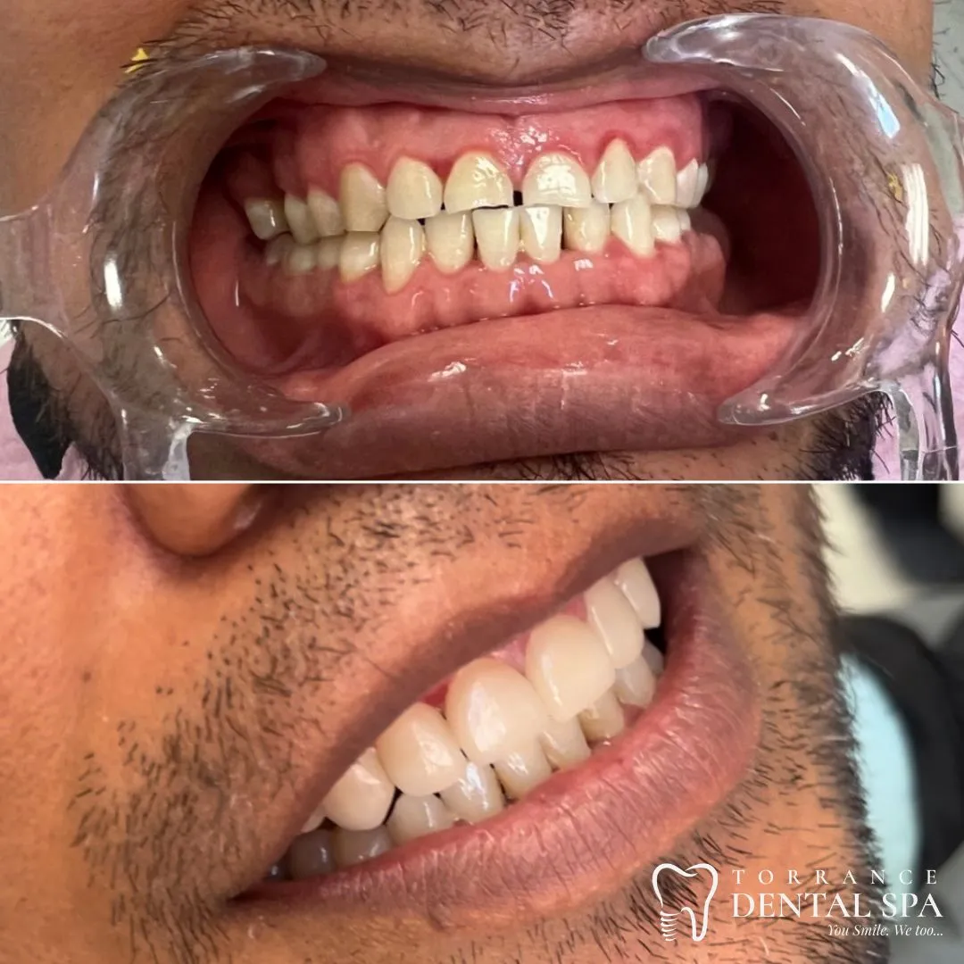 Before and after — smile case 2
