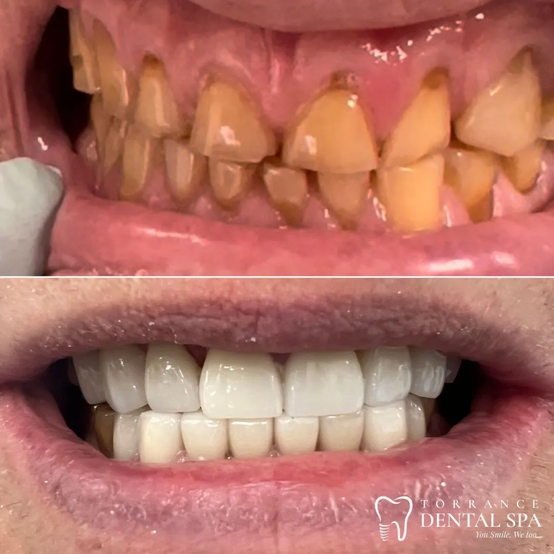 Before and after — smile case 3