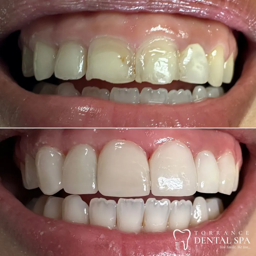 Before and after — smile case 4