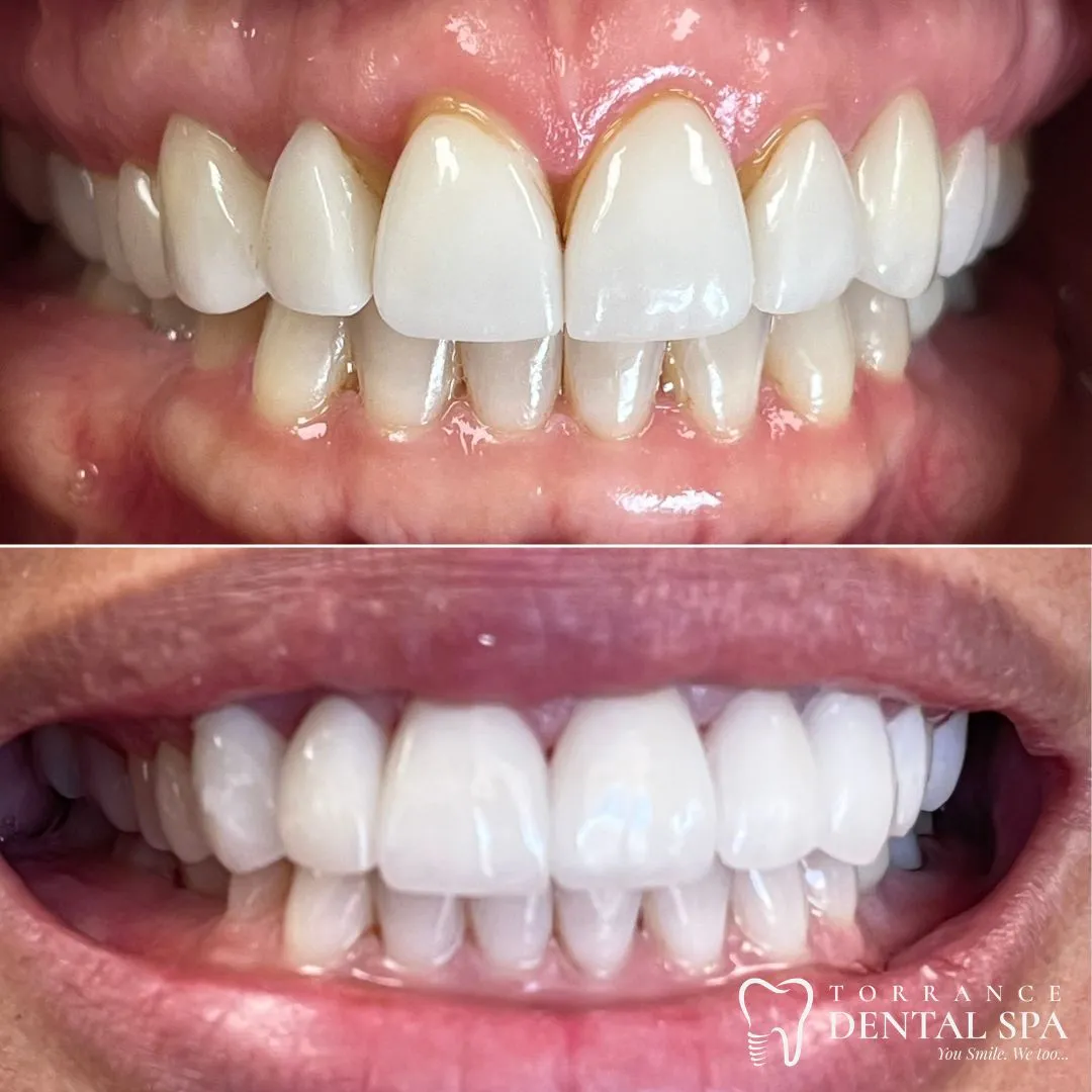 Before and after — smile case 5