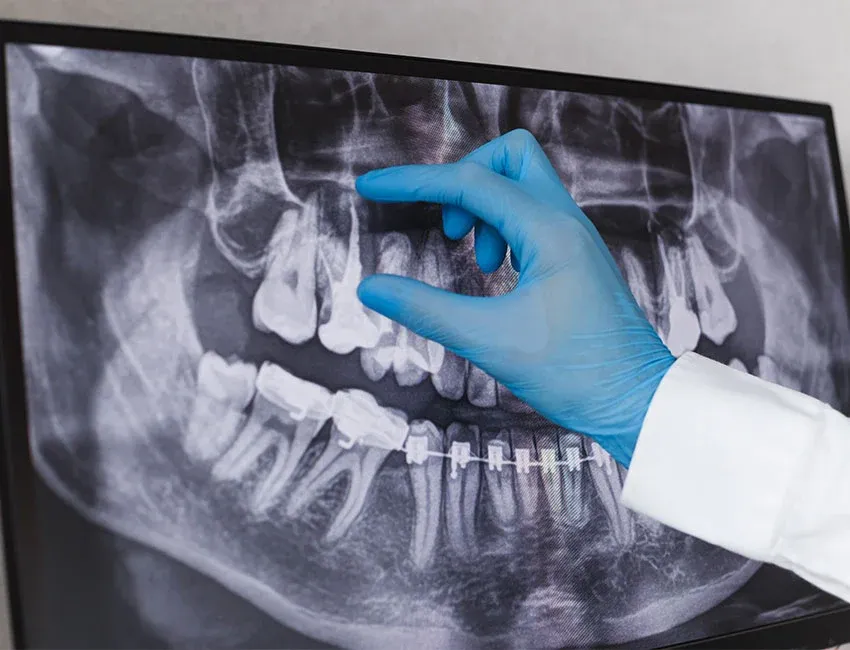 Signs you may need root canal therapy — Torrance Dental Spa