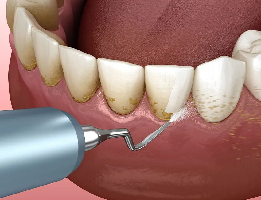Teeth Cleaning and Dental Hygiene at Torrance Dental Spa