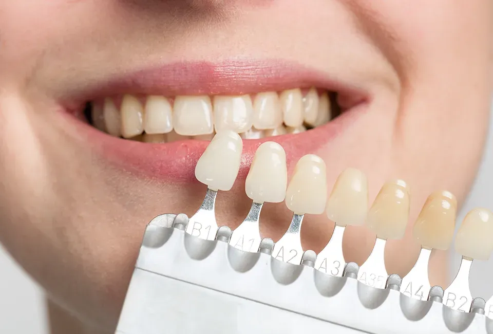 How Can I Find a Teeth Whitening Dentist in Torrance?