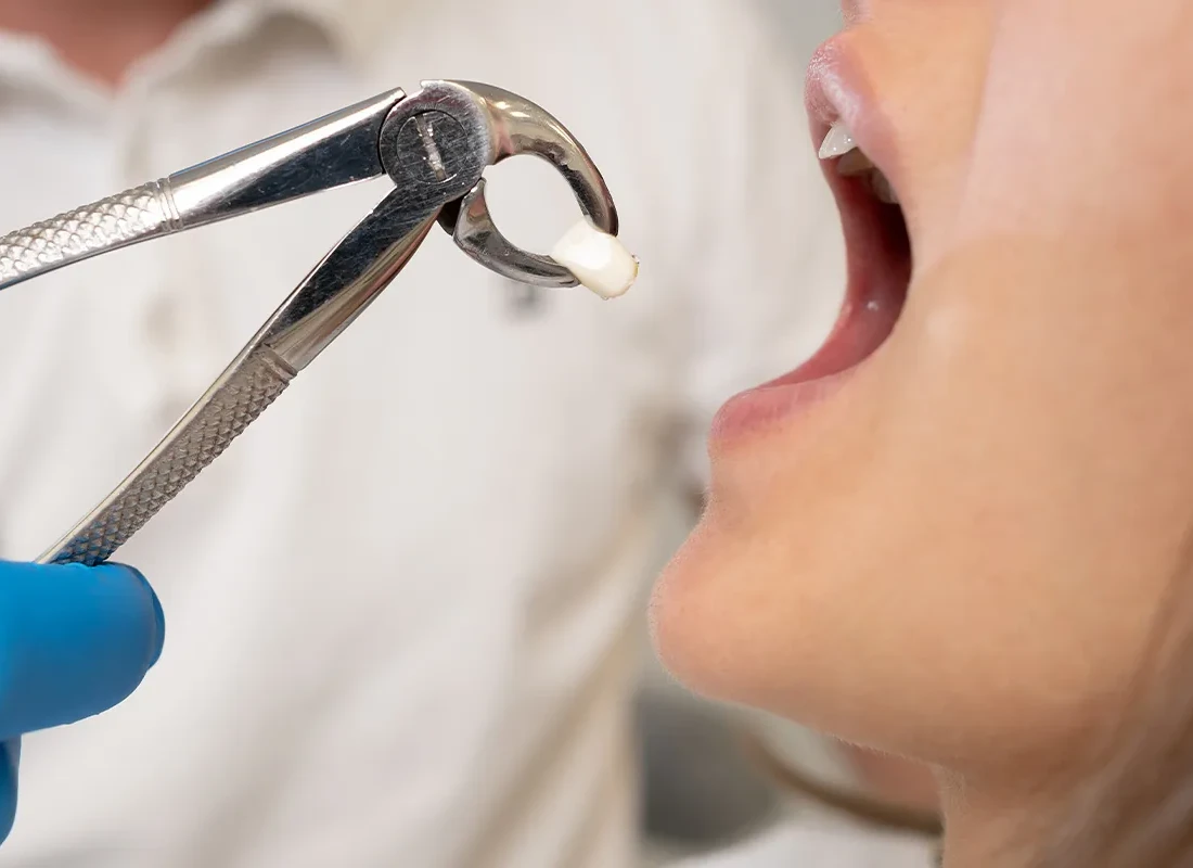 Tooth Extraction at Torrance Dental Spa