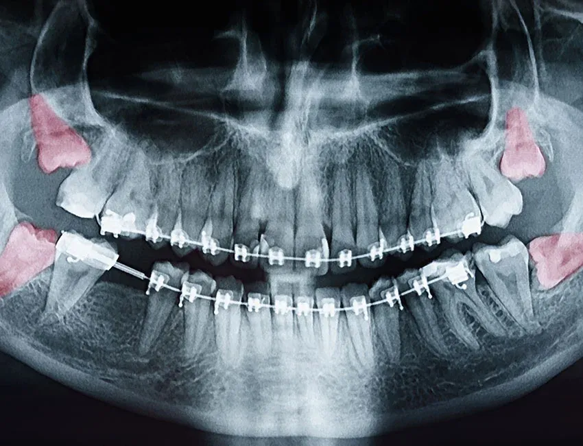 Wisdom Teeth Removal at Torrance Dental Spa