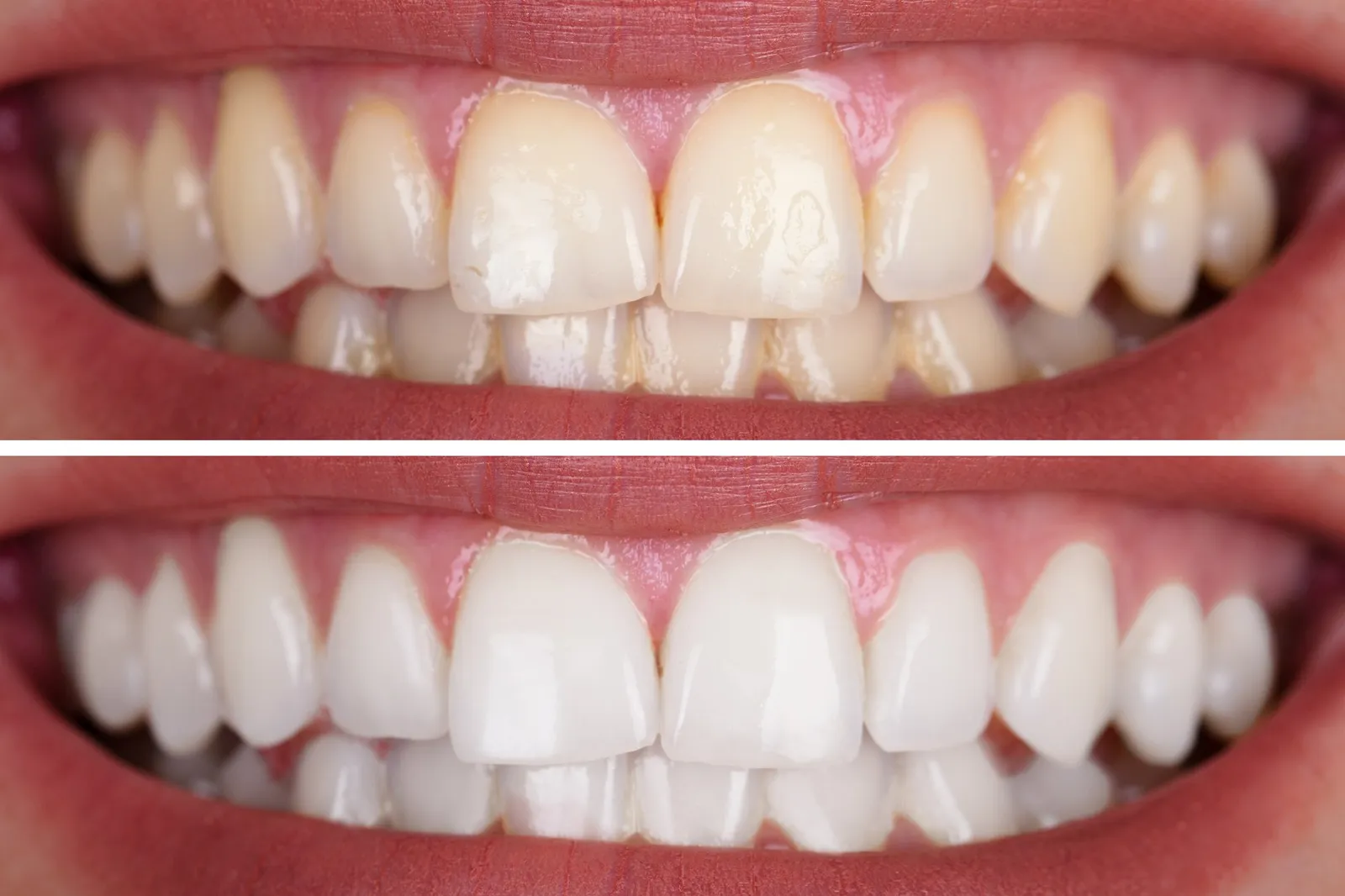 What Causes Yellow Teeth Even With Regular Brushing?